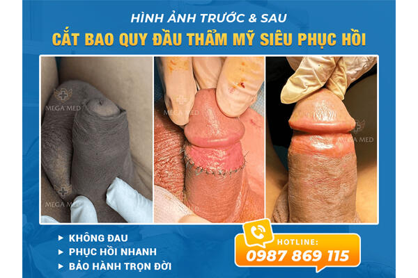 Hình ảnh cắt bao quy đầu thẩm mỹ